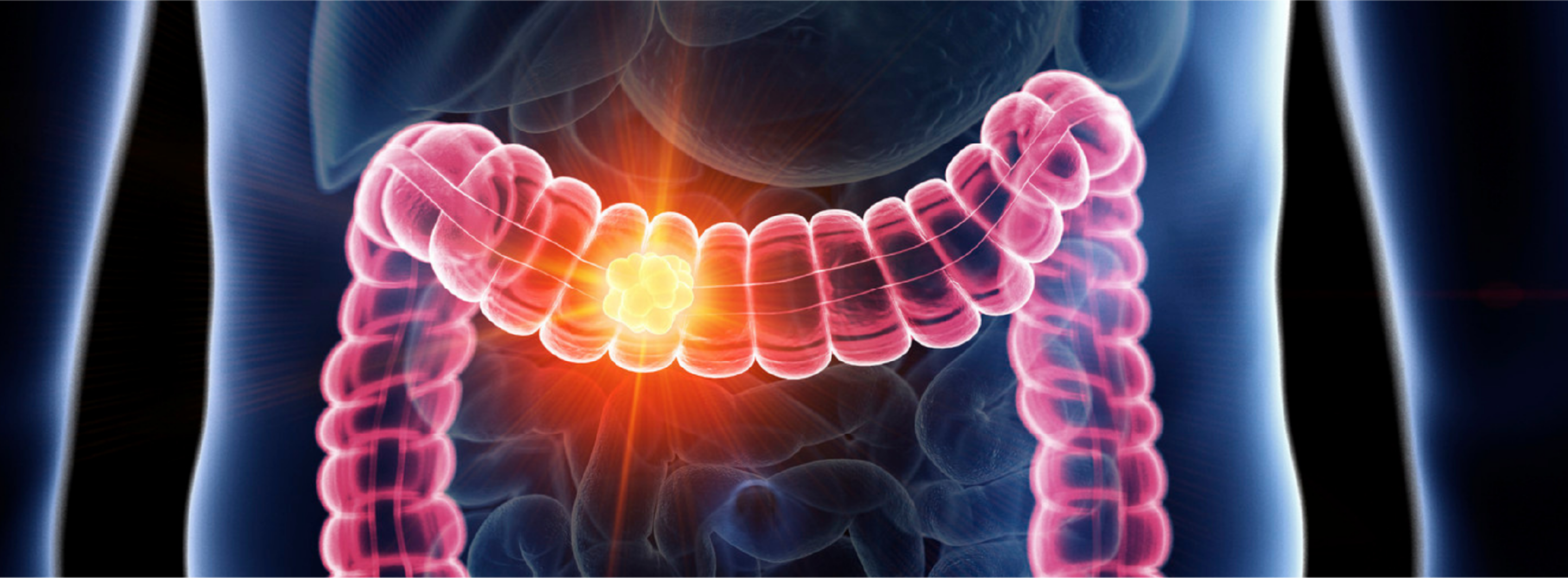 Colorectal cancer