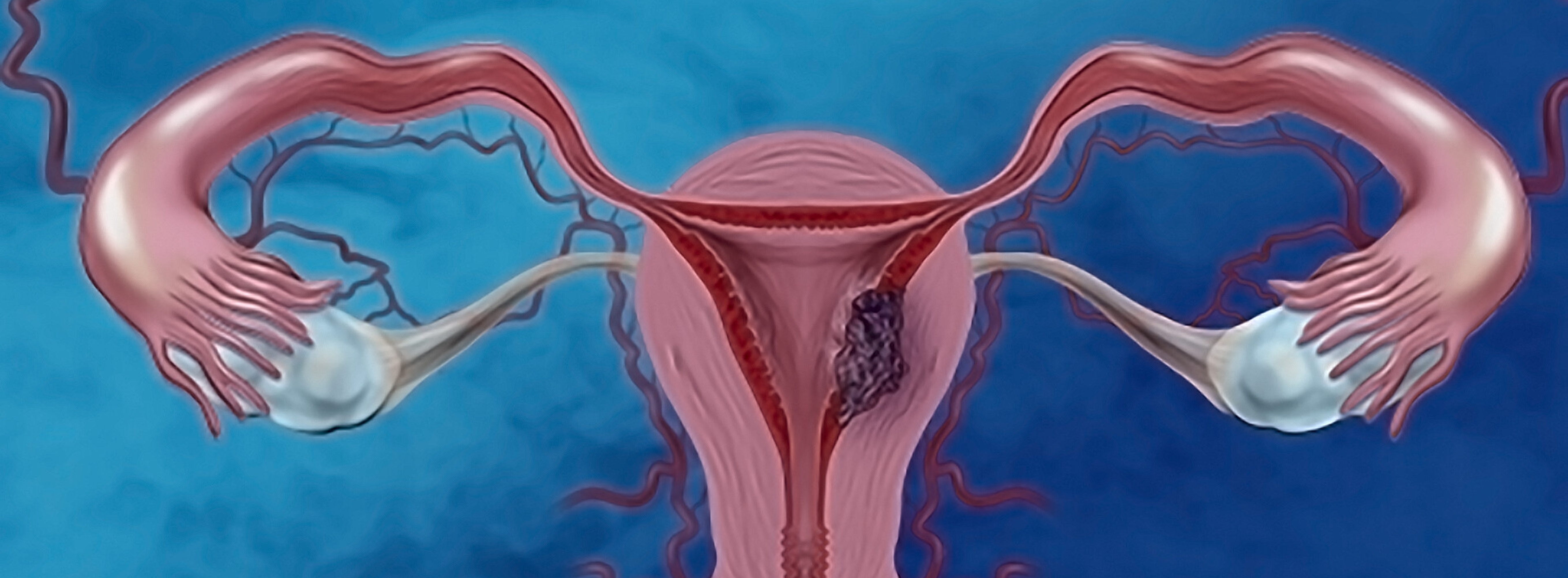 Gynecological Cancer