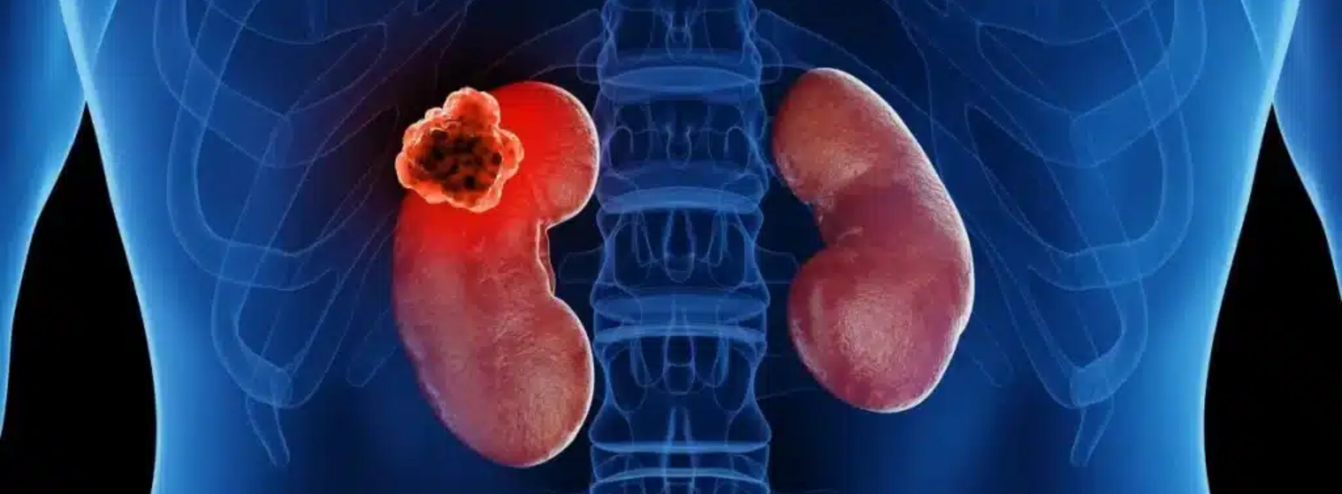 Kidney Cancer