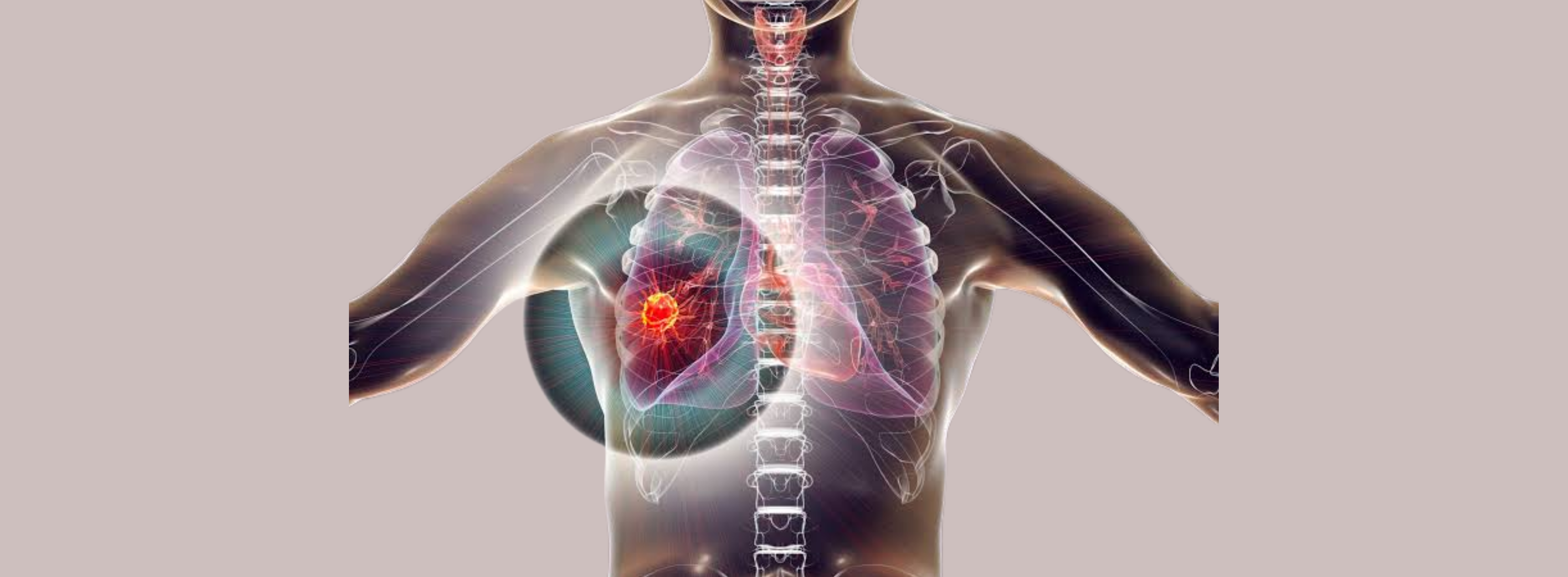 Lung Cancer