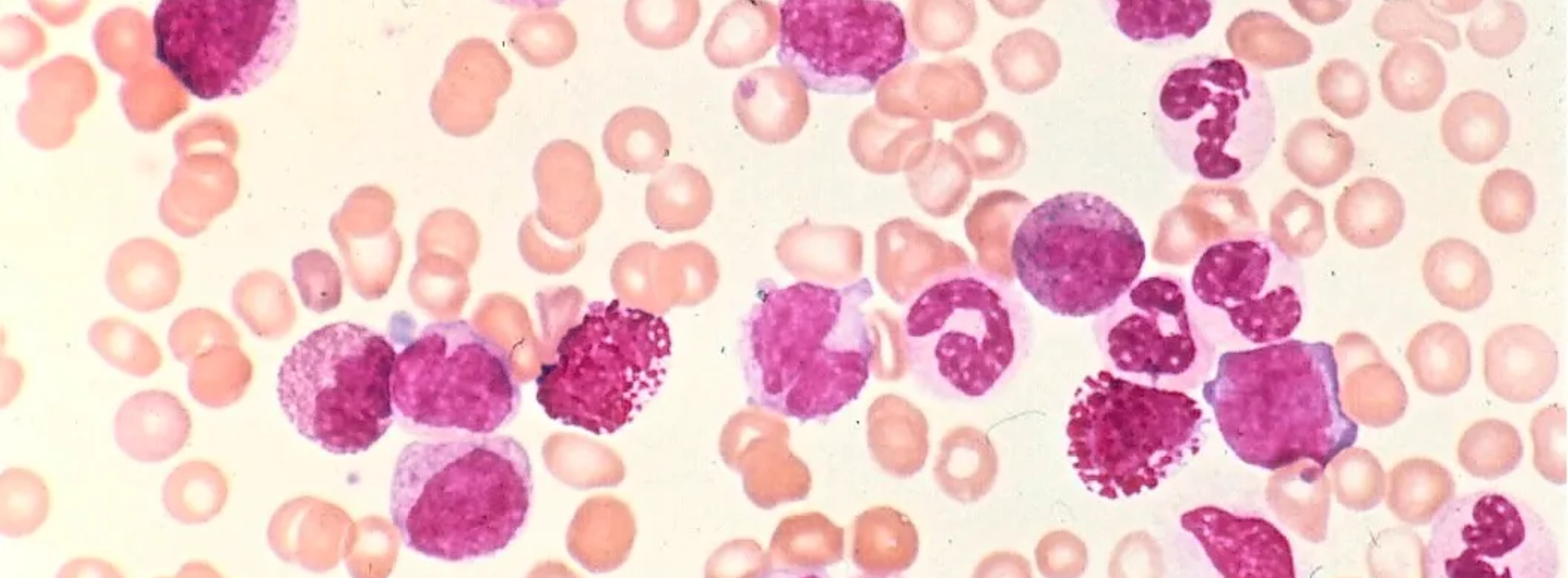 Lymphomas & Leukemias