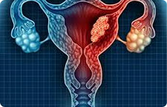 Gynecological Cancers