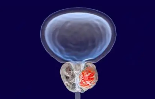 radioligand-therapy-cancers